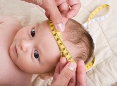 Registro de microcefalia é falho, diz estudo