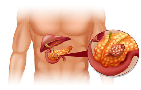 Conheça sintomas do Câncer de pâncreas e saiba como se prevenir